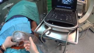 ULTRASOUND GUIDED STELLATE GANGLION BLOK
