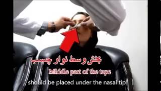 How to tape nose after rhinoplasty (in English)