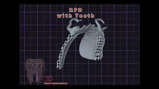 Removable Partial Denture with Teeth (RPD)