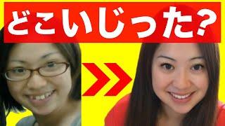歯並び最悪女が歯列矯正で整形級に顔と人生が激変したお話#1/Aparelho para mudar vida/Japanese crooked teeth