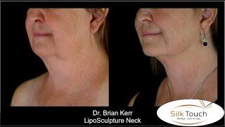 Liposuction Before and After Photos by Brian Kerr MD, Silk Touch Medspa Boise Idaho