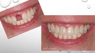 Dental Implant Crowns & Bridges - Julie M. Gillis, DDS - Grand Junction, CO