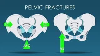 Pelvic trauma Imaging