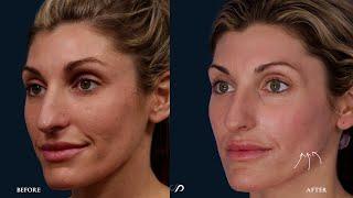 CO2 Laser Resurfacing | Fine lines and Wrinkles | Dr. David Stoker