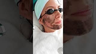 PICOSECOND HOLLYWOOD PEEL