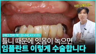 [대진다] 녹아버린 잇몸 무작정 수술하면 안됩니다..│틀니 부작용, 임플란트 수술과정, 앞니 임플란트, 임플란트 종류, 상악동 거상술│EP.85