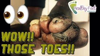 Fungal, Ram Horned Nails on Deformed Feet by Podiatrist Dr. Binh Nguyen. Fungal Toenails.
