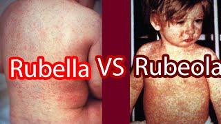 Rubella vs Rubeola  (Measles vs German Measles)