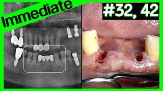 [Online Surgery] #32,42 Lower anterior immediate implant placement