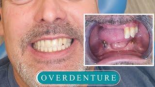 Affordable Overdentures at The Smile Mission in Miami