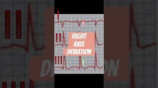 Right axis deviation