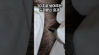 모발이식 대신 두피문신하는 이유