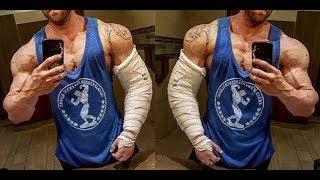 Tricep tear rehab VLOG BPC 157 and TB 500