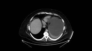 Gastric outlet obstruction