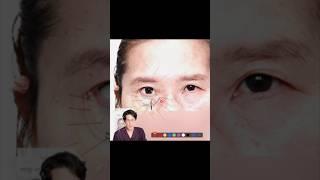 Ep6-3.리프팅공부 ▶︎ 레이저눈밑지 더이상 속지마세요 제1탄 / 유지인대의 중요성 ▶︎ #대구눈밑지방재배치 #레이저눈밑지방재배치 #앙코르 #대구이마거상 #대구성형외과
