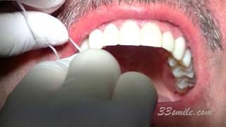 Video of Dr. John Moore Improving a Man's Teeth with Dental Veneers at  Cosmetic Dental Associates