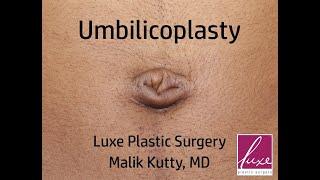 Umbilicoplasty for a woman with excess skin inside her belly button. Done with local anesthesia.