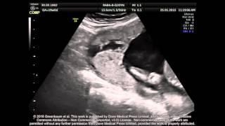 Sonography of placenta percreta (fourth pregnancy) – Video S1 [ID 100321]