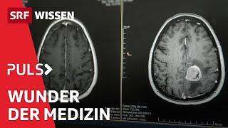 Unheilbar krank und doch genesen – Wenn Medizin «Wunder» schafft | Puls | SRF Wissen