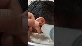 Ear wax removal || Syringing #medical #facts #earwax #shorts #shortsvideo #viral #trending #ent