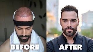 Hair Transplant Results: Seven-Month Update | Before and After | Istanbul, Turkey with Hairneva