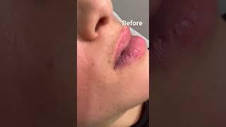 Signature Non-Shaving Upper Lip Laser Hair Removal