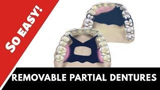 Partial dentures | ɪɴᴅɪᴄᴀᴛɪᴏɴꜱ & ᴄᴏɴᴛʀᴀɪɴᴅɪᴄᴀᴛɪᴏɴꜱ |