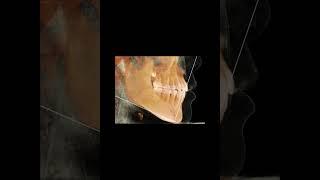 改訂版　CT KaVo 3D eXam and Anatomage Invivo5 software after orthodontic treatment