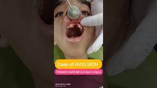 Tooth Fell out of Mouth! Watch what we did next! Dr. Srishti Bhatia #teeth #accident #smile