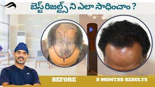 Hair Transplant In Vizag | Best Results Surgeon Clenter & Results Of Hair Transplant In Vizag