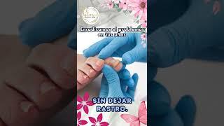 Eliminacion de HONGOS en las Uñas con Laser #hongosenlasuñas #fungustreatment #fungus