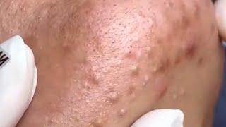 Nice video of big blackheads! Relax and enjoy! Cravos gigantes, cistos, espinhas, pimple popping.