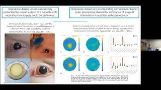 2022 Scleral Lens Research Update