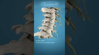 What is Cervical Degenerative Disc Disease? #Shorts