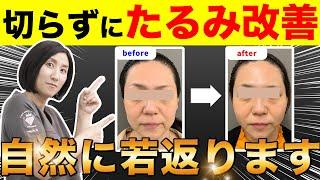 【若返り】切らずにたるみ解消！口横のたるみの治療方法を徹底解説