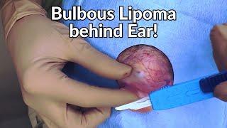 what the sigma dermatologist rizzles lipoma from behind the ear!