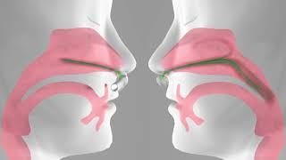 Arseus Medical présente: Hi-VNI par Vapotherm - High Velocity Nasal insufflation