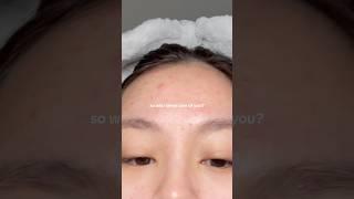 This is your reminder that it gets better #kbeauty #acne #acneproneskin #acnepositivity