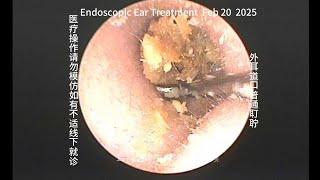 Reliable cleaning of ordinary earwax in the external auditory canal 20250220