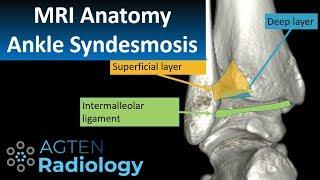 MRI Anatomy of Ankle Ligaments: Syndesmosis