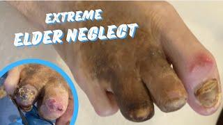 EXTREME ELDER NEGLECT.
