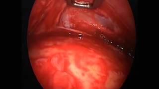 Endoscopic Resection of a Lipoma of the Forehead