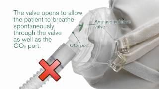 Intersurgical's FaceFit™ NIV mask with anti-asphyxiation valve