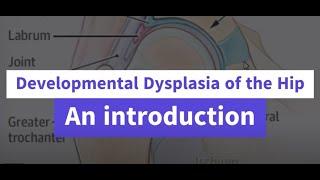 Developmental Dysplasia of the Hip an introduction