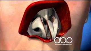 Rhinoplasty - 3D Medical Animation || ABP ©