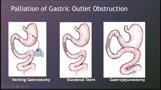 Advanced Endoscopic Approaches to Inpatient GI Conditions
