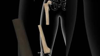 4 Most Painful Femur Shaft Fractures