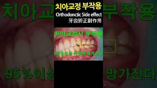 치아교정 부작용. 씹을때 아픈 이유. 교합유도가 안 나오는 환자. DentiTube2023.09.12