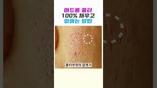  여드름 흉터 100% 채우고️없애는 방법  (여드름 닥터) #여드름흉터 #피부관리 #skincare #여드름흉터없애는방법
