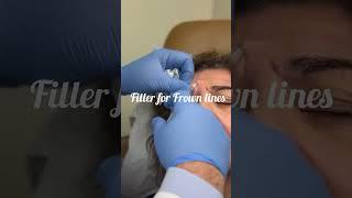 Filler for Frown Lines